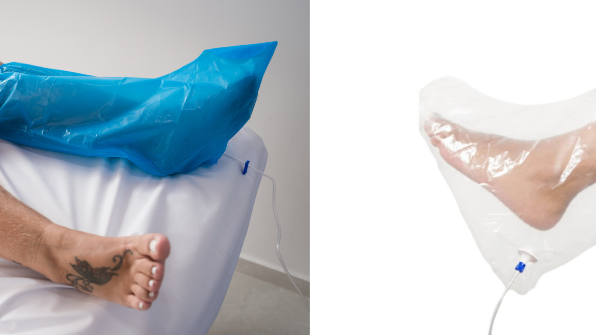 Ozonioterapia para Tratamento de Feridas